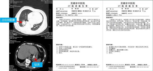 小鈦夾，威力大 ——記一例上消化道大出血患者的救治經(jīng)過(圖2)