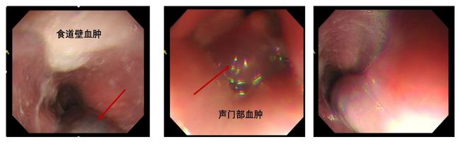 小異物，大后果 ——一個(gè)消化科醫(yī)生的日記(圖1)