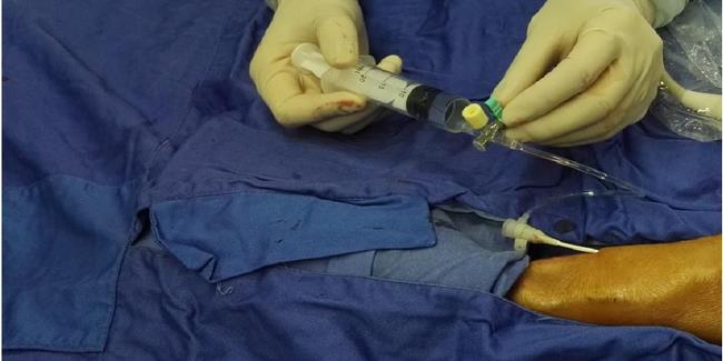 我院血液凈化中心成功開展首例B超下經皮腔內血管成形術（PTA）(圖1)