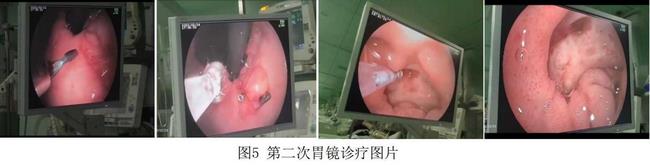 癡呆老人命懸一線，內(nèi)鏡止血彰顯奇功(圖3)