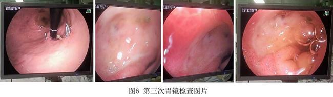 癡呆老人命懸一線，內(nèi)鏡止血彰顯奇功(圖4)