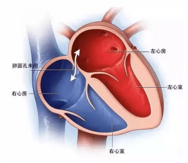 探尋不明原因卒中、偏頭痛根源的檢查技術(shù)—TCD發(fā)泡試驗(yàn)(圖1)