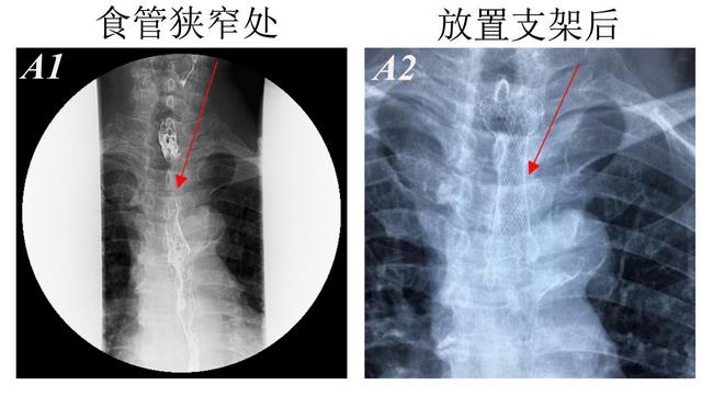消化科運用多學科會診（MDT）微創(chuàng)診治食管惡性腫瘤侵潤所致食、氣道梗阻(圖4)