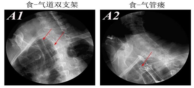 消化科運用多學科會診（MDT）微創(chuàng)診治食管惡性腫瘤侵潤所致食、氣道梗阻(圖8)