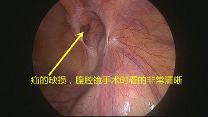 切口小，當(dāng)天即可生活自理——外三科開展腹腔鏡下疝氣手術(shù)(圖1)