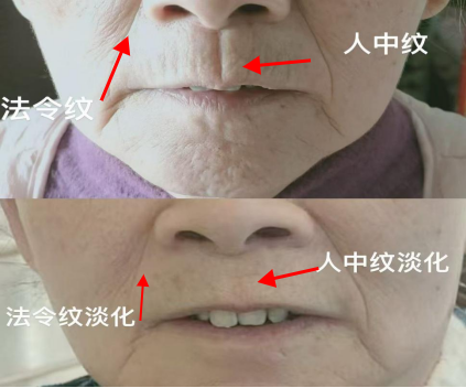 繡花針+黑科技：超微針灸定顏術(shù)助您優(yōu)雅抗衰(圖3)